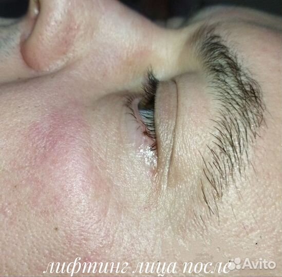 Сахарное моделирование фигуры и лифтинг лица