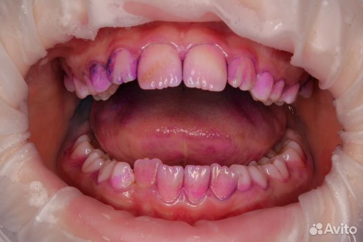 Фотоаппарат Canon для стоматологии