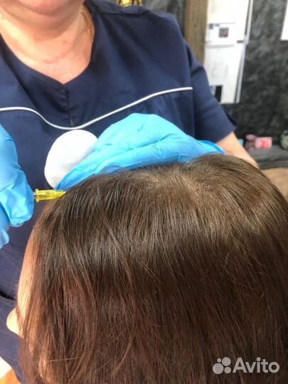 Карбокситерапия