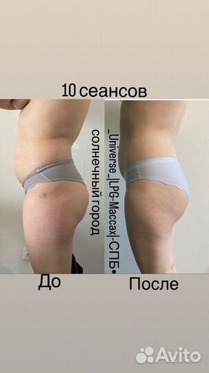 LPG массаж тела и лица. Ручной массаж. Медовый