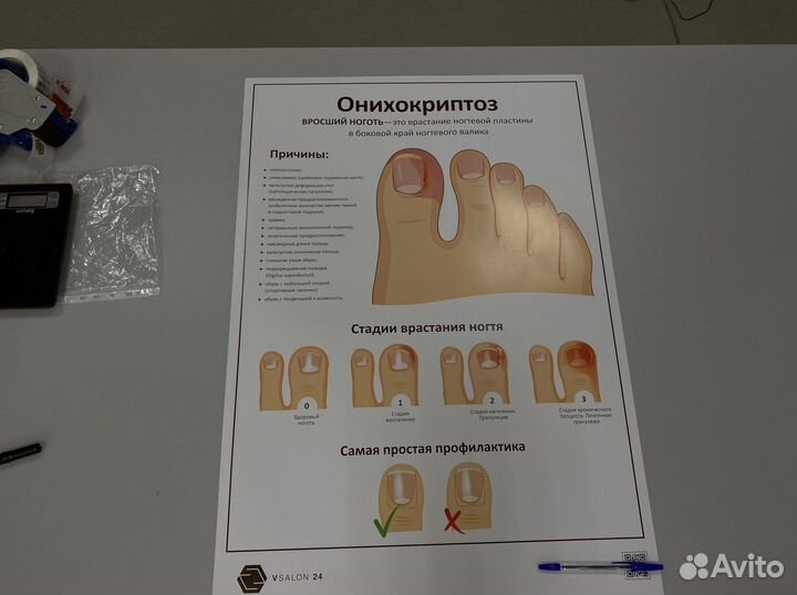 Плакат онихокриптоз