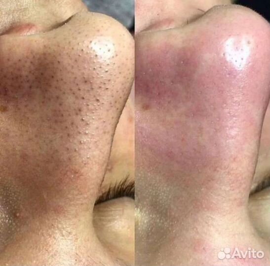 Чистка лица