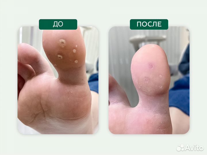 Медицинский, подологический педикюр, подолог