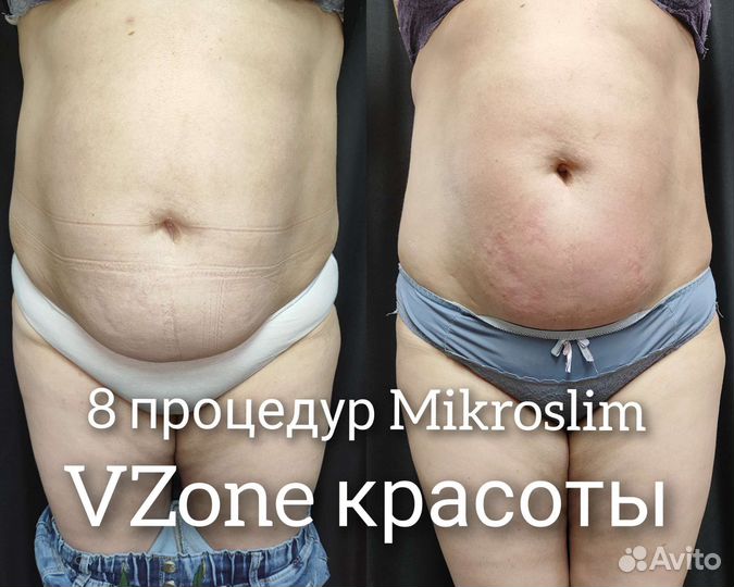 Курс жиротоп,модели на подтяжку живота