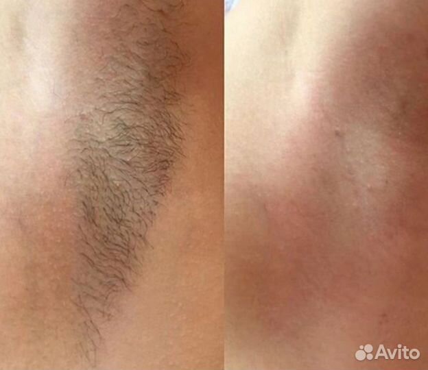 Спа-шугаринг