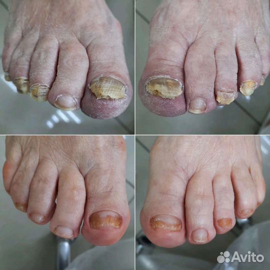 Подологическая зачистка. Подолог с выездом на дом