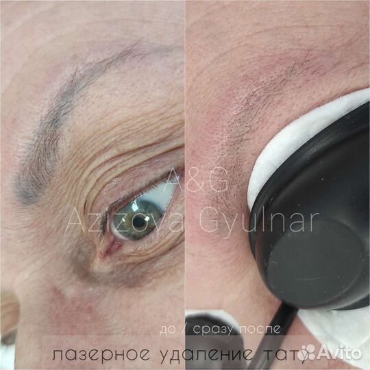 Удаление тату/татуажа (перманента)