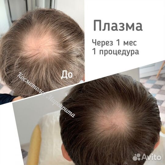 Косметолог/Челны/Плазмолифтинг/Плазмогель