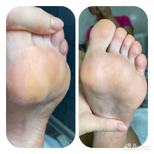 Smart педикюр медицинский педикюр