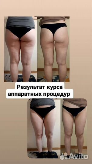 Кавитация,рф лифтинг,вакуум массаж,миостимуляция