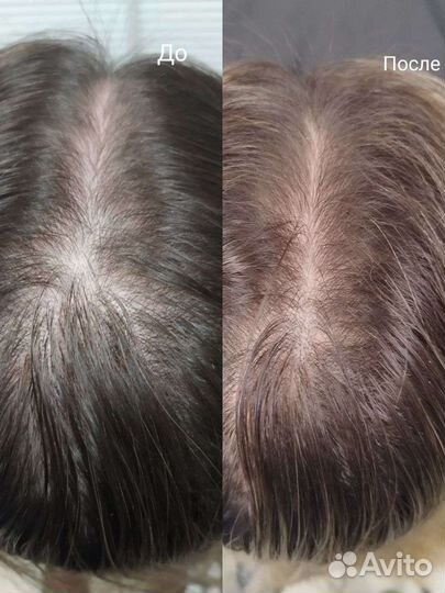 Лечение выпадения волос