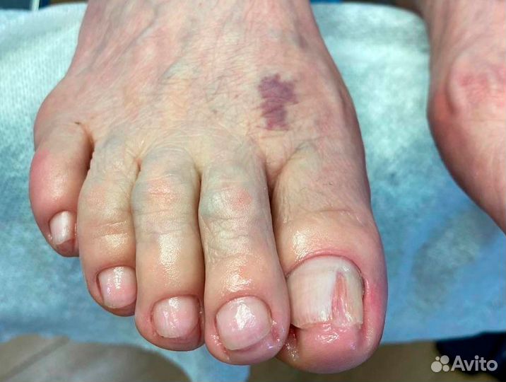 Медицинский педикюр - Подолог