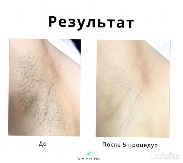 Аппарат для эпиляции Люминес. MaxOne 1200