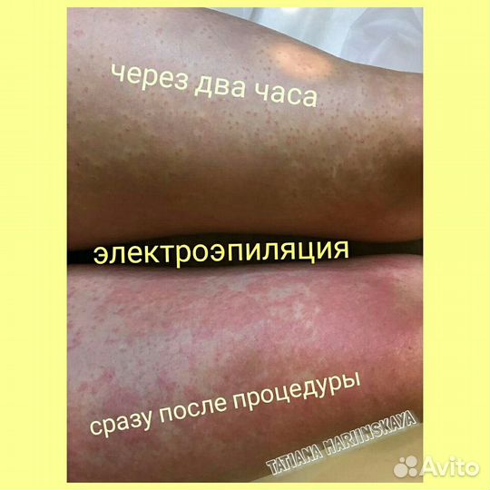 Электроэпиляция