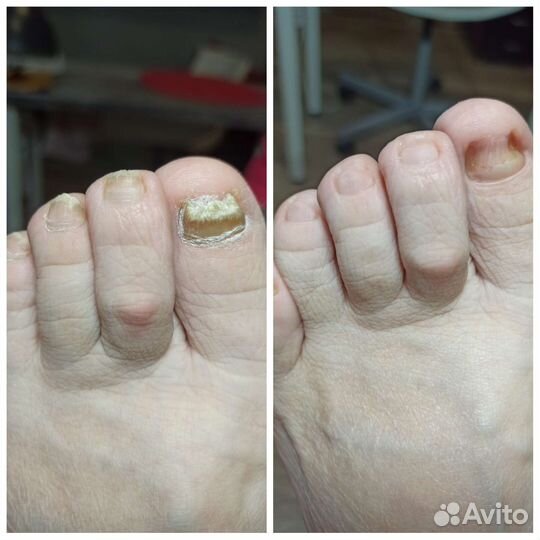 Smart педикюр, Гигиенический педикюр