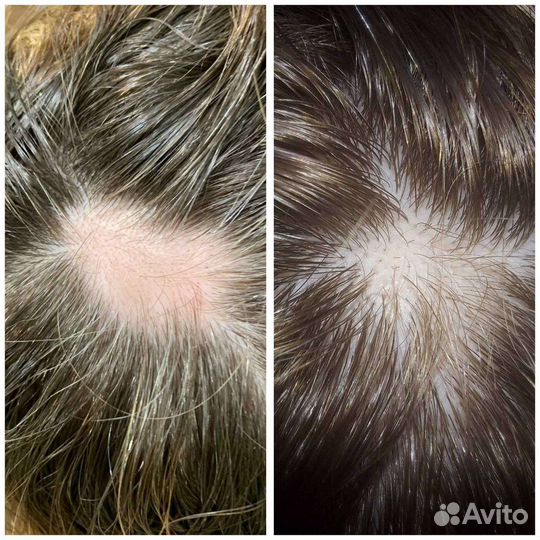 Лечение выпадения волос