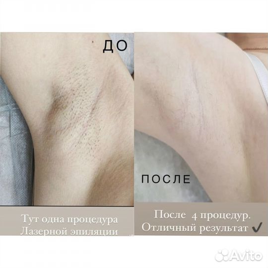 Лазерная эпиляция
