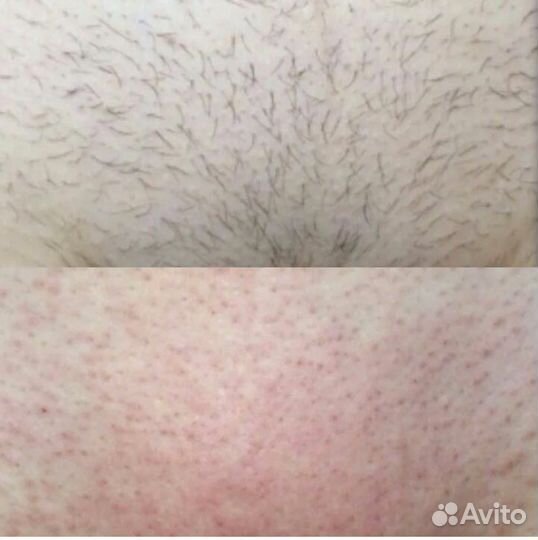 Электроэпиляция - Лазерная эпиляция