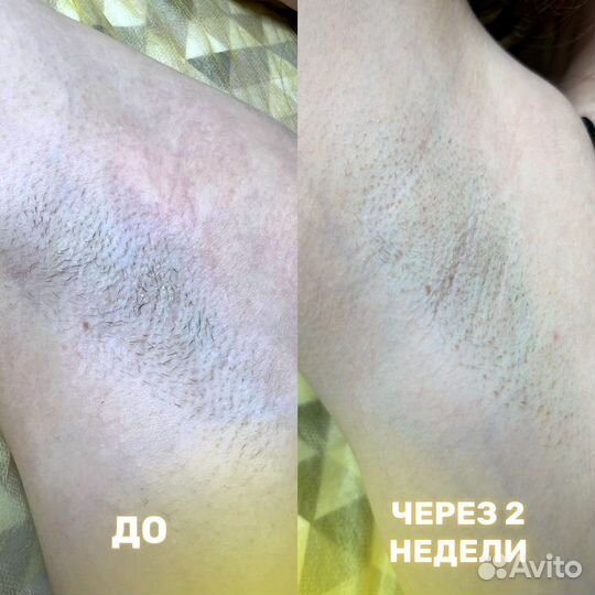 Электроэпиляция