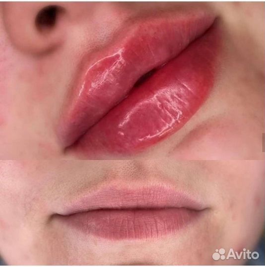 Контурная пластика