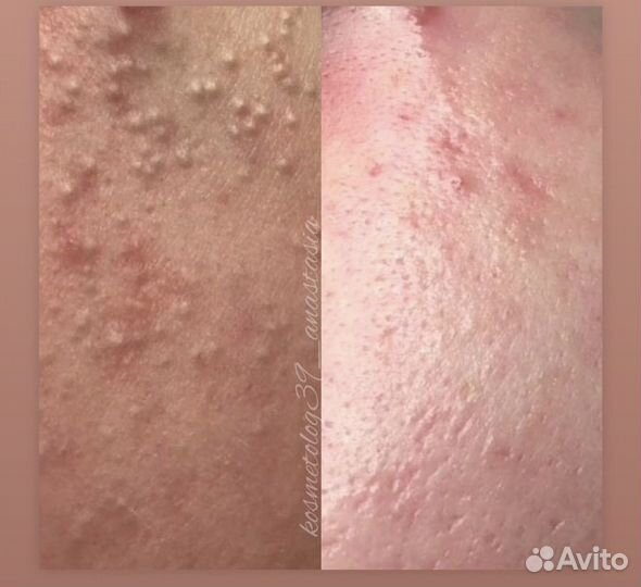 Чистка лица пилинг калининград