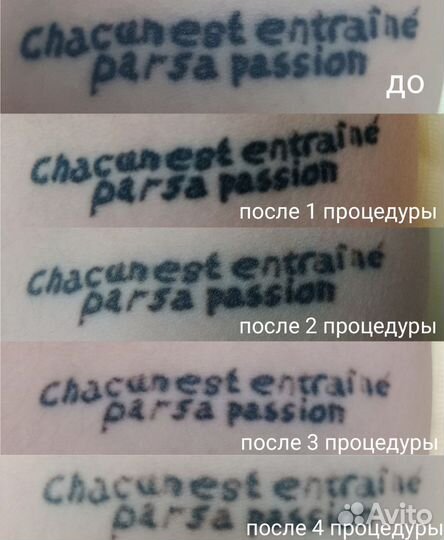 Лазерное удаление татуажа, перманента, тату