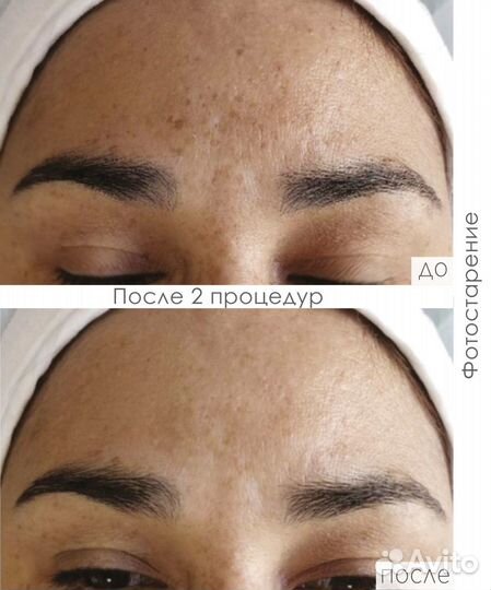 DermaQues «мангобрайт» Набор на 4 процедуры