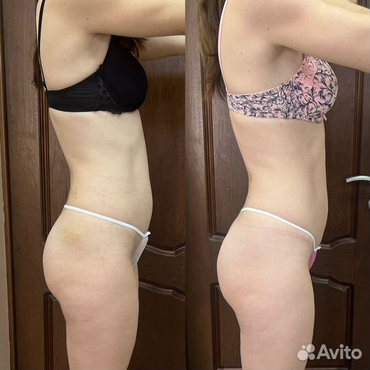 Антицеллюлитный массаж, коррекция фигуры