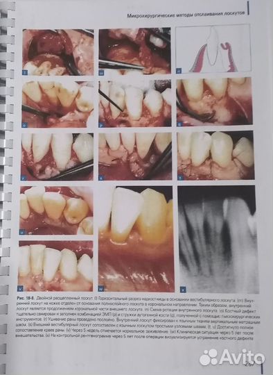 Регенерация пародонта