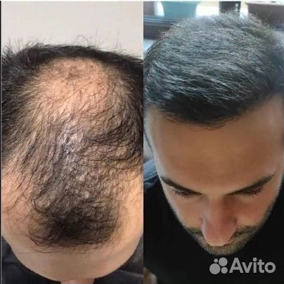 Пересадка волос Гарантия/ Качество/ Результат