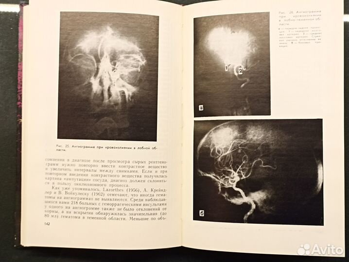 Хирургия острых мозговых инсультов. 1970