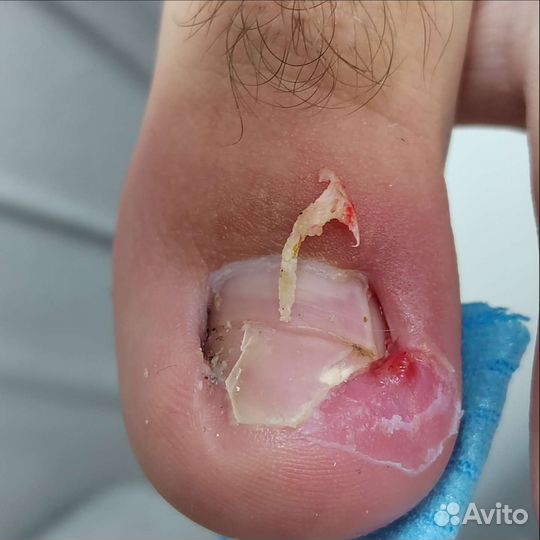 Услуги подолога с выездом на дом