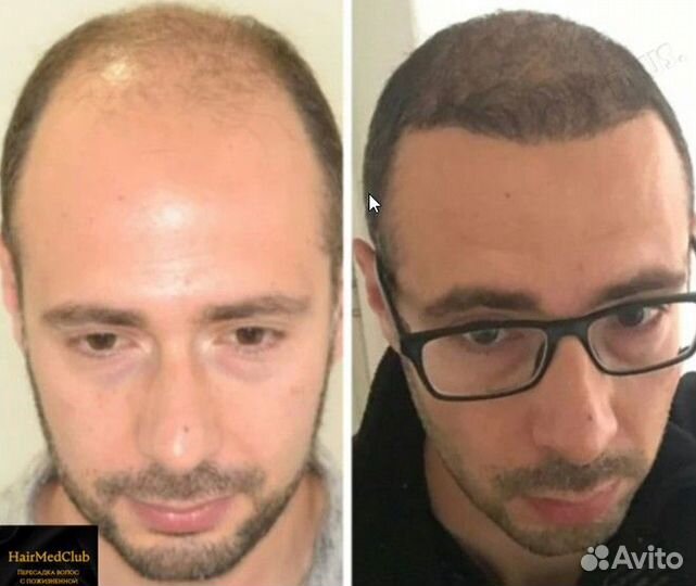 Пересадка волос современным методом FUE