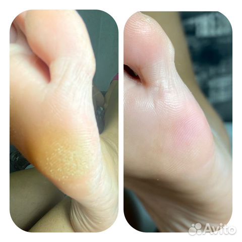 Smart педикюр медицинский педикюр