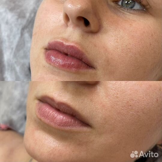 Увеличение губ