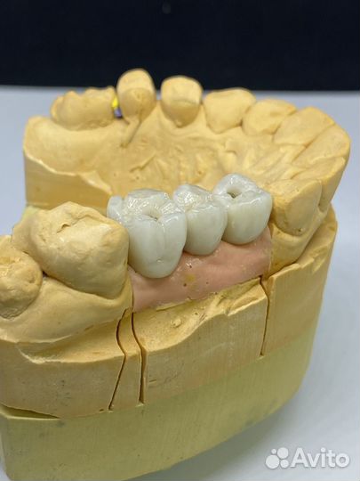 Коронки зубные изготовление