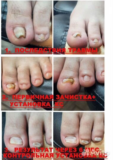 Педикюр, подолог (вросшие ногти, трещины пяток)