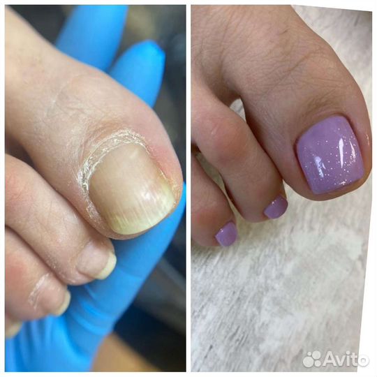 Аппаратный педикюр