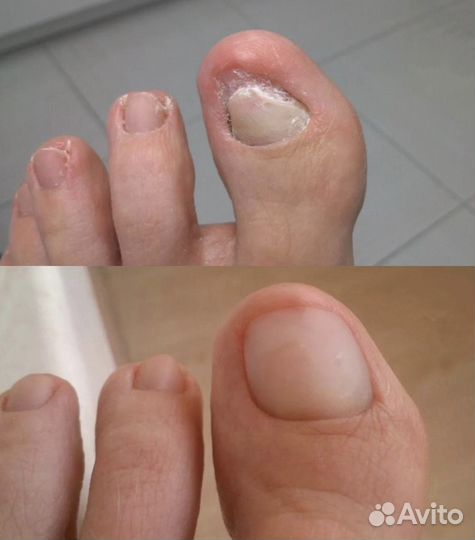 Подологический педикюр