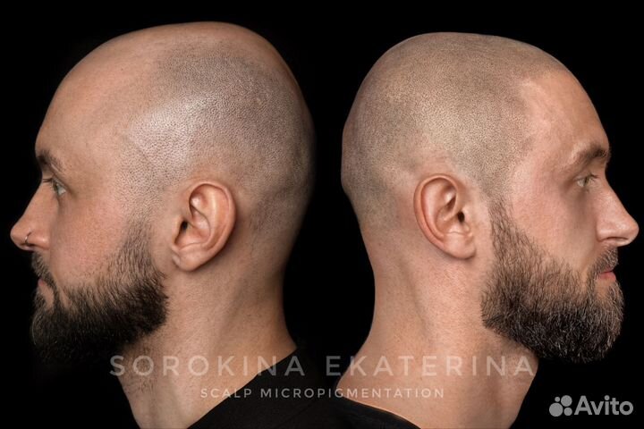 Трихопигментация головы