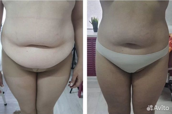 Плоский живот - размер за 1 процедуру в Перми