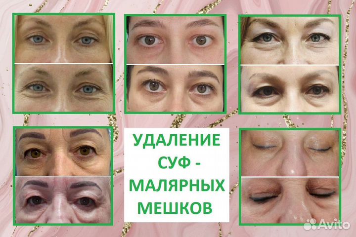 Холодный импульсный спрей, омоложение на 10 лет