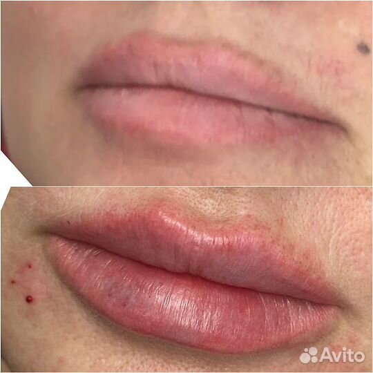 Контурная пластика губ