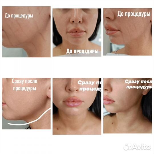 Смас лица, тела, подтяжка фигуры