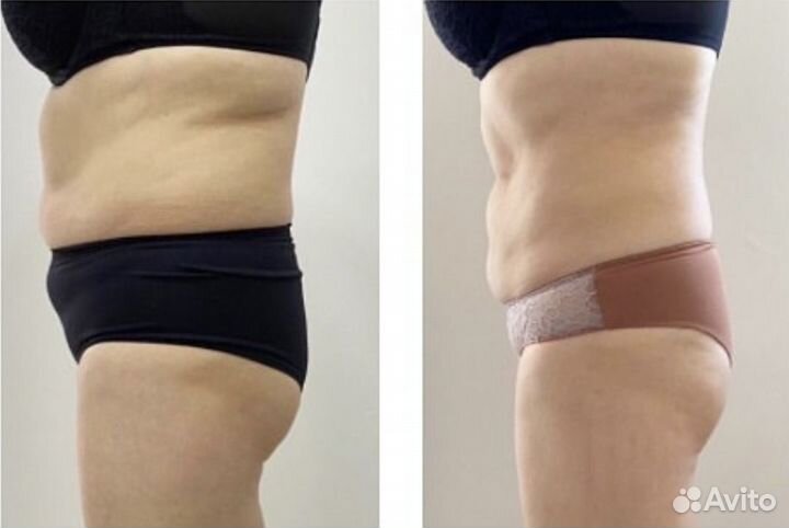 Жиротоп. Липолитики для тела у топ-косметолога