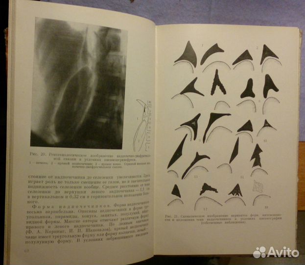 Л.И.Перепуст. Рентгенодиагностика. Опухолей надпоч