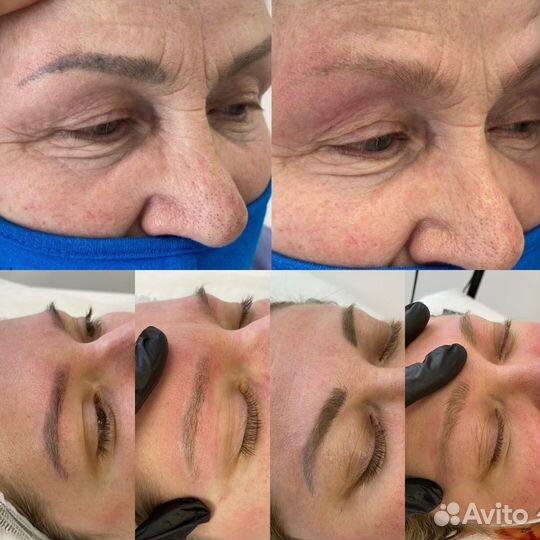 Удаление татуажа и тату