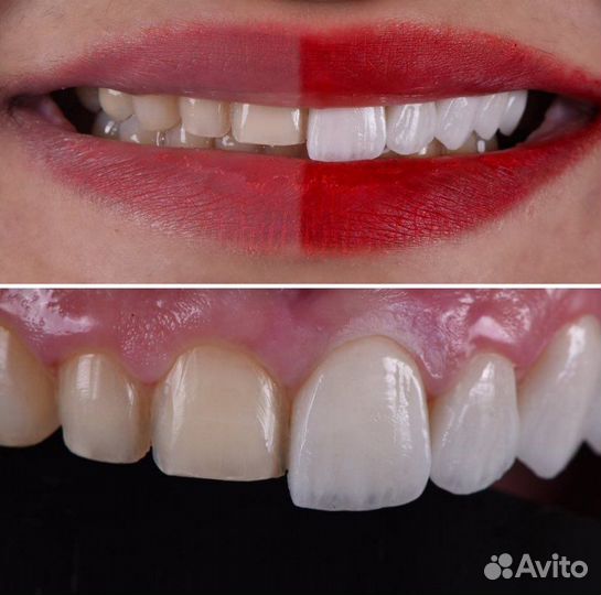 Голивудская улыбка