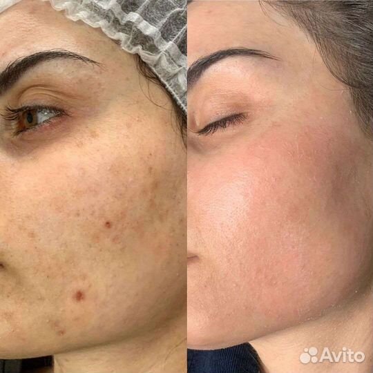 Пилинг для лица