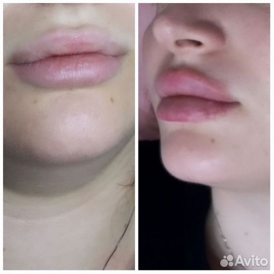 Модель на увеличение губ